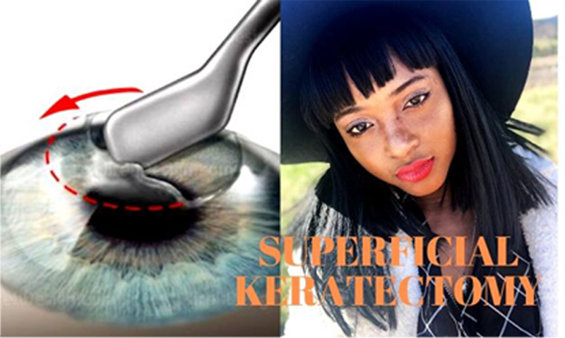 HEALING PROCESS: SUPERFICIAL KERATECTOMY (AKA CORNEAL SCRAPING ...